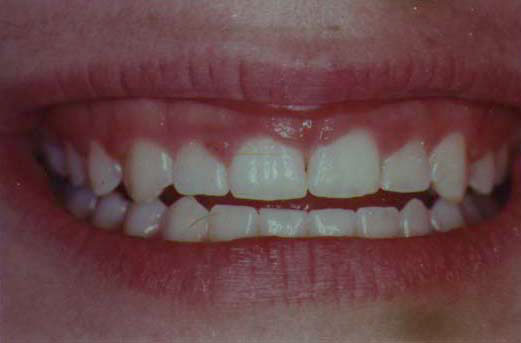 Inadaquate "Normal" Gum Recession