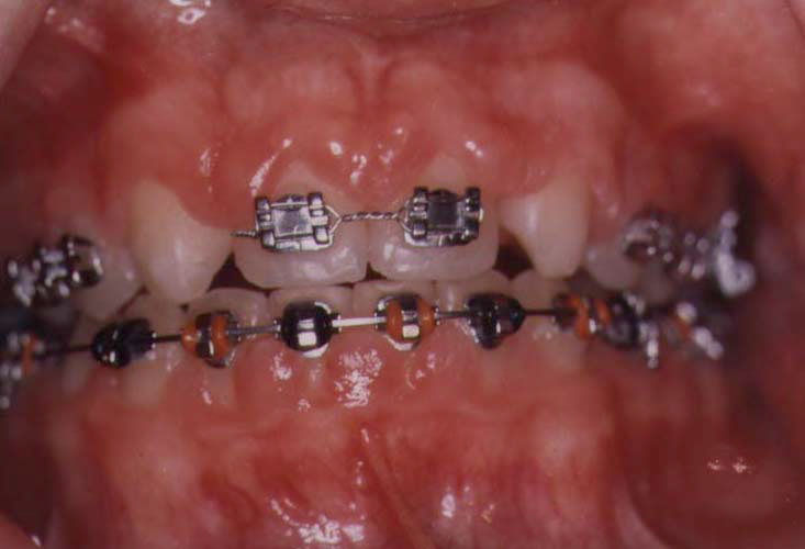 braces